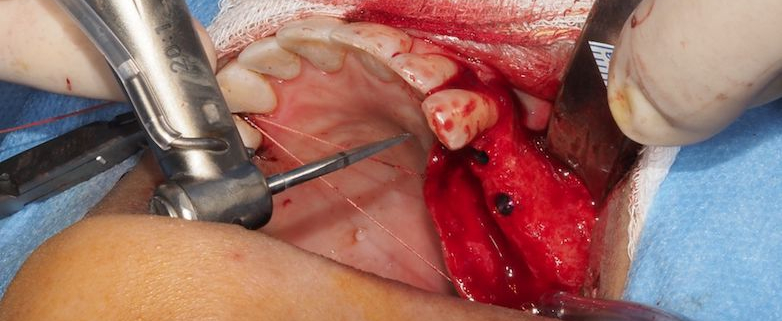 Formation complète implantologie dentaire - Cursus en 4 modules