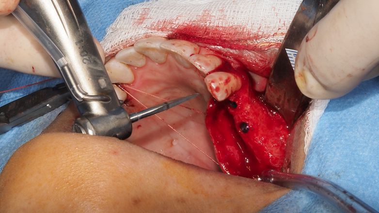 Formation complète implantologie dentaire - Cursus en 4 modules