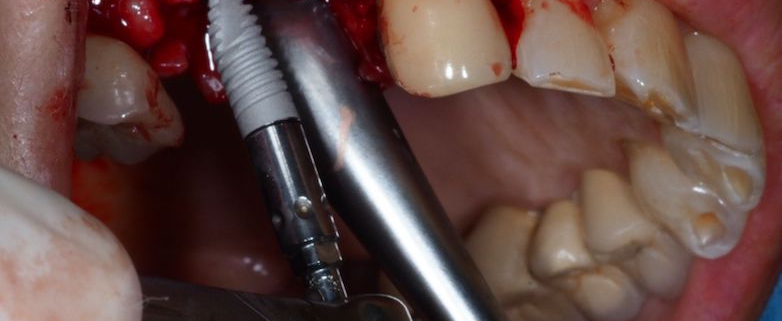 Masterclass endodontie - Chirurgie endodontique