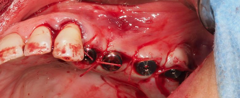 Masterclass - Prothèse implantaire