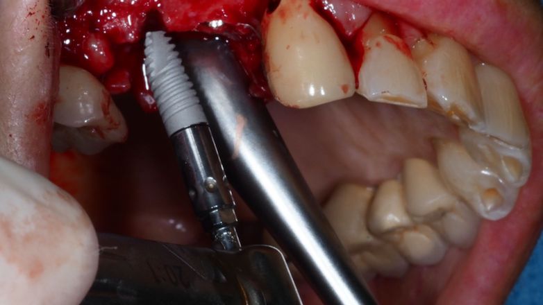 Formation complète implantologie dentaire - Cursus en 4 modules