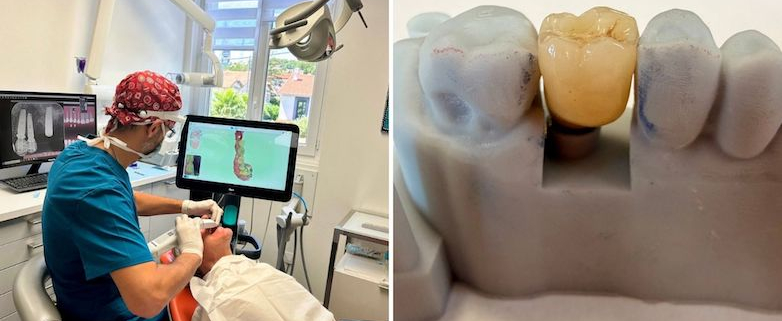 Formation implantologie dentaire - Module 2 - La prothèse sur implant