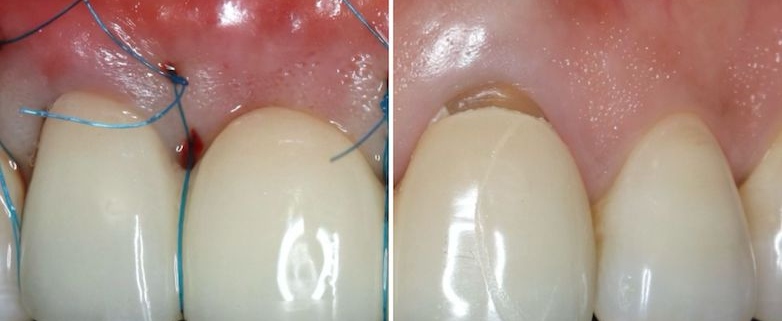 Formation parodontologie - Module 2 - Greffe gingivale libre, entre héritage et modernité