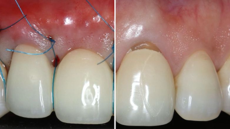Formation parodontologie - Module 2 - Greffe gingivale libre, entre héritage et modernité