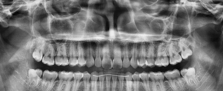 Masterclass chirurgie dentaire - Extractions complexes et dents de sagesse