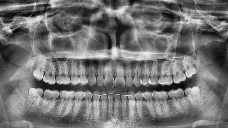 Masterclass chirurgie dentaire - Extractions complexes et dents de sagesse